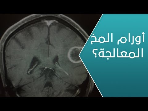 ما خطورة إجراء عملية إزالة أحد أورام المخ ؟ - العيادة