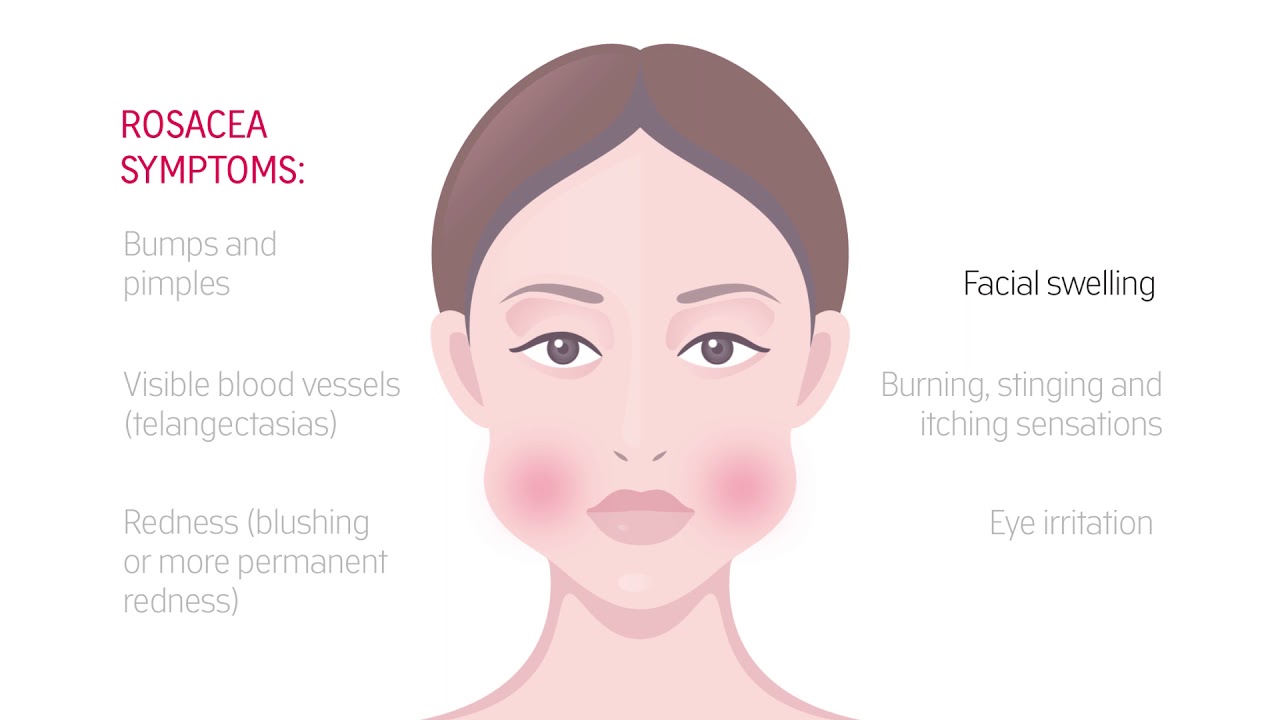 Розацея это такое у женщин схема. Розацея стадии развития. Розацея это такое у женщин схема лечения симптомы. Розацея у новорожденных.