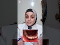 Management of Shark teeth || Dr. Hager Adel