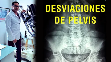 ¿Cuáles son los síntomas de una pelvis desalineada?