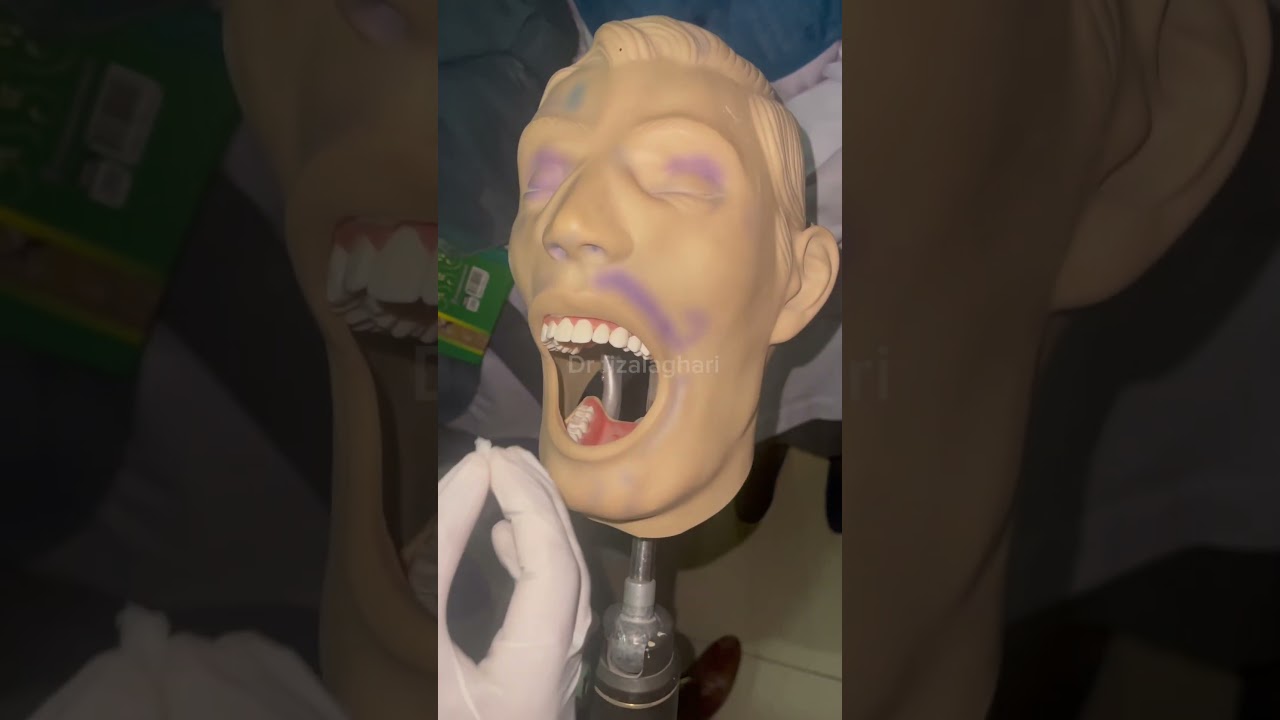 Cold test for pulp vitality test 