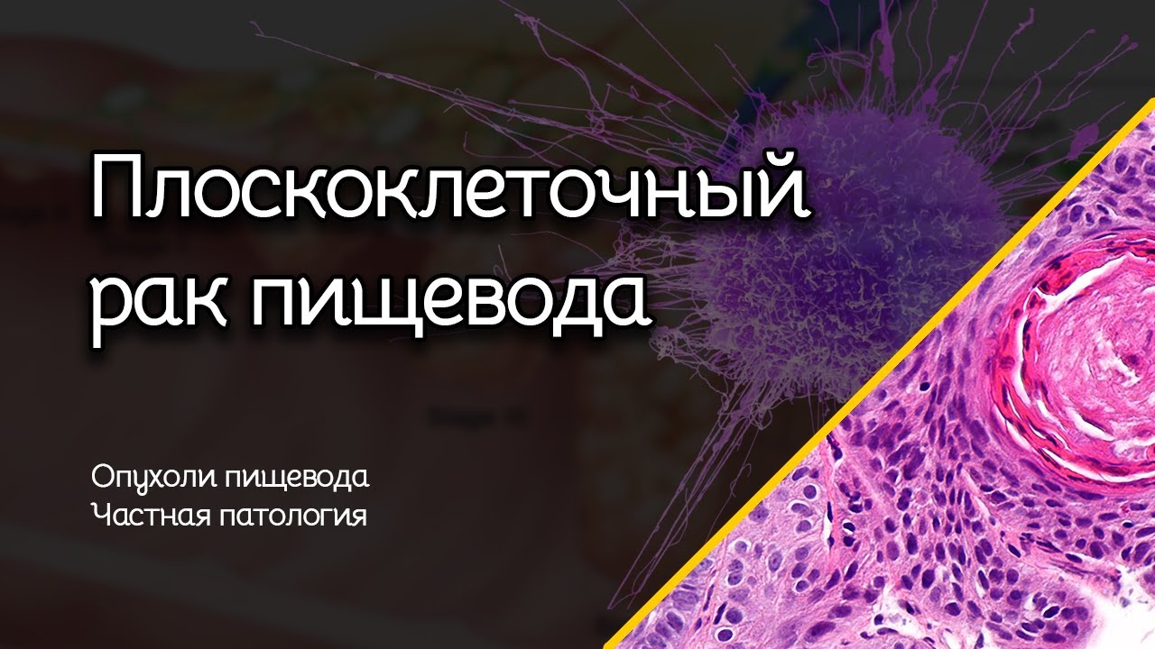 Плоскоклеточный рак пищевода | Опухоли пищевода | Частная патология ...