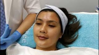 Adeline Tsen's Journey: Brighter, Clearer skin with Carbon Peel Laser