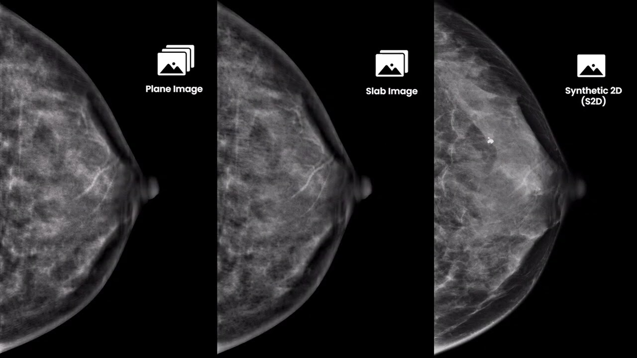 [AIDIA LUXE] 3D Tomosynthesis, Reimaging Excellence in Breast Imaging with precision
