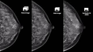 Aidia Luxe 3D Tomosynthesis, Reimaging Excellence In Breast Imaging With Precision