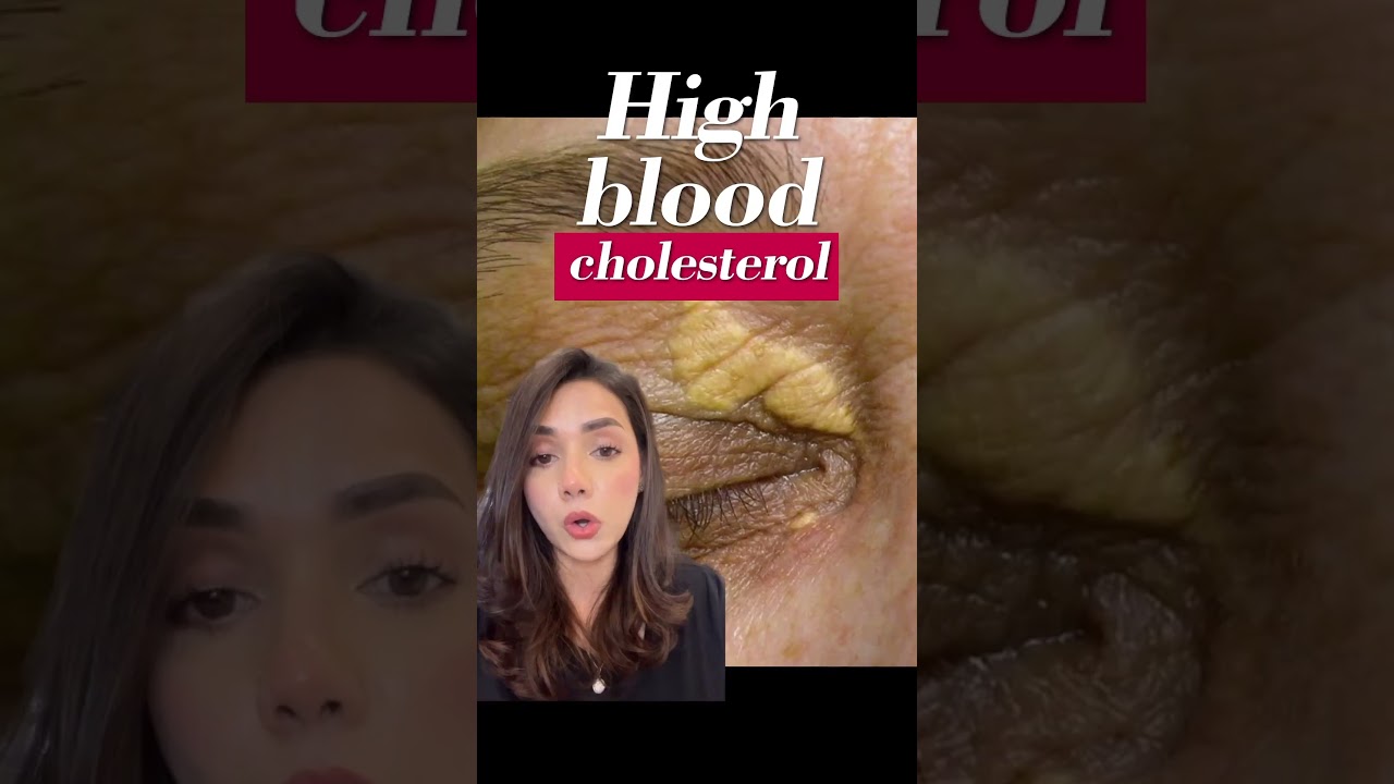 How to treat Xanthelasma? 