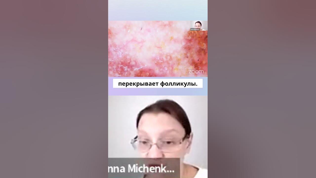 Лентиго меланома часть 2 - YouTube