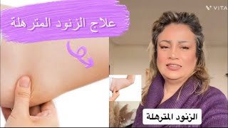 ٢٠: علاج ترهل الزنود في الطب الصيني