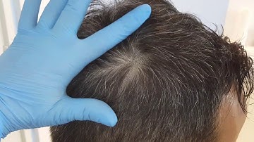 Scar SMP Healed Scalp Micropigmentation by El Truchan @ Scalp Micro Definition