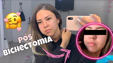 Como melhorar o resultado da bichectomia?