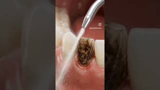 Signs You Need a Dental Cleaning ASAP 🚨