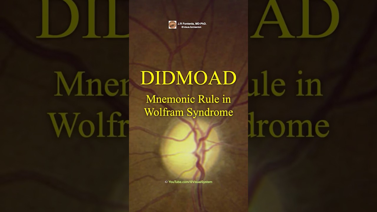 Wolfram Syndrome. DIDMOAD, Mnemonic Rule.