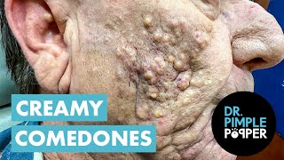 Dr Pimple Poppers Creamiest Comedones