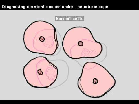 Pap Smear Cervical Cells under Microscope