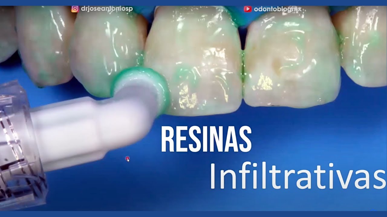 Resinas Infiltrativas