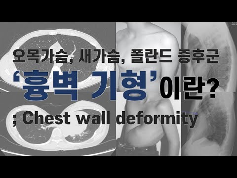 [흉부학개론] 오목한 가슴, 돌출된 가슴! 흉벽기형 이란? / 오목가슴 / 새가슴 / 강남 세브란스 병원 이성수 과장님