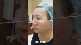 SMAS лифтинг HIFU#альтернатива пластической операции #до#после