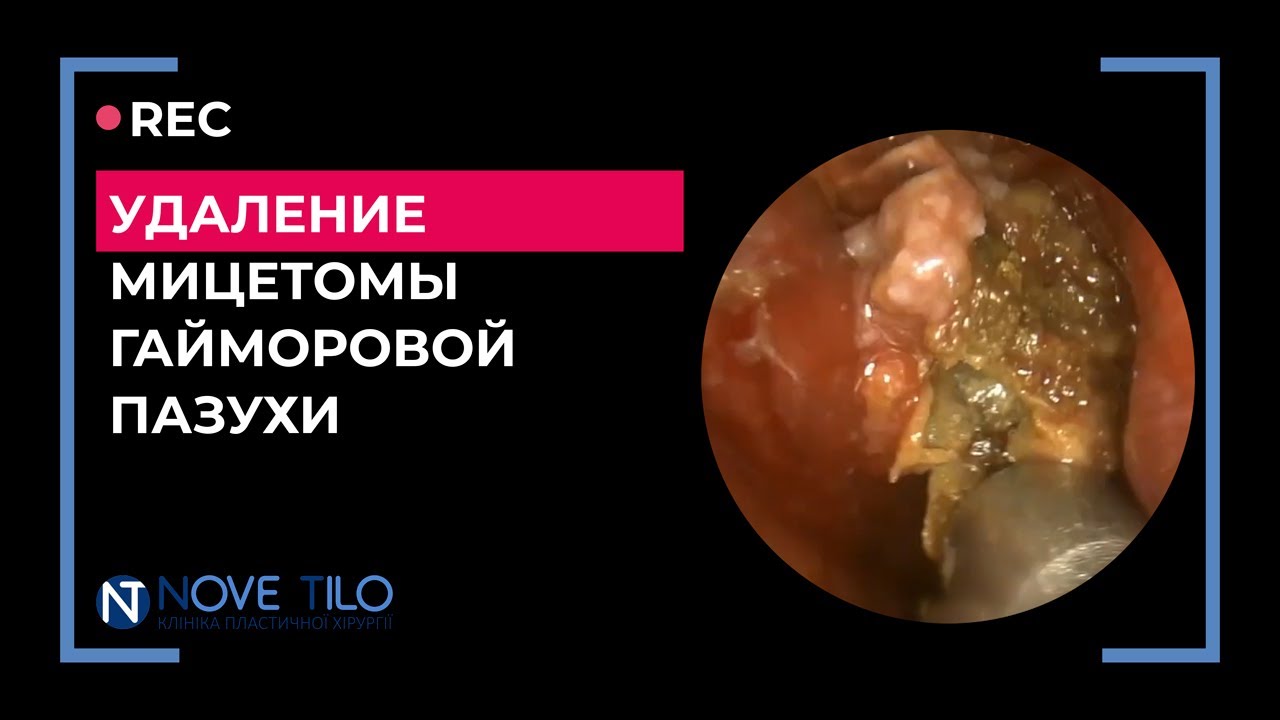 Удаление мицетомы гайморовой пазухи