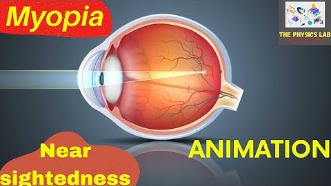 Myopia | Eye Defect | with Animation