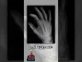 كسر الساعد اليد احمد حسين تقدر تحدد مكان الكسر