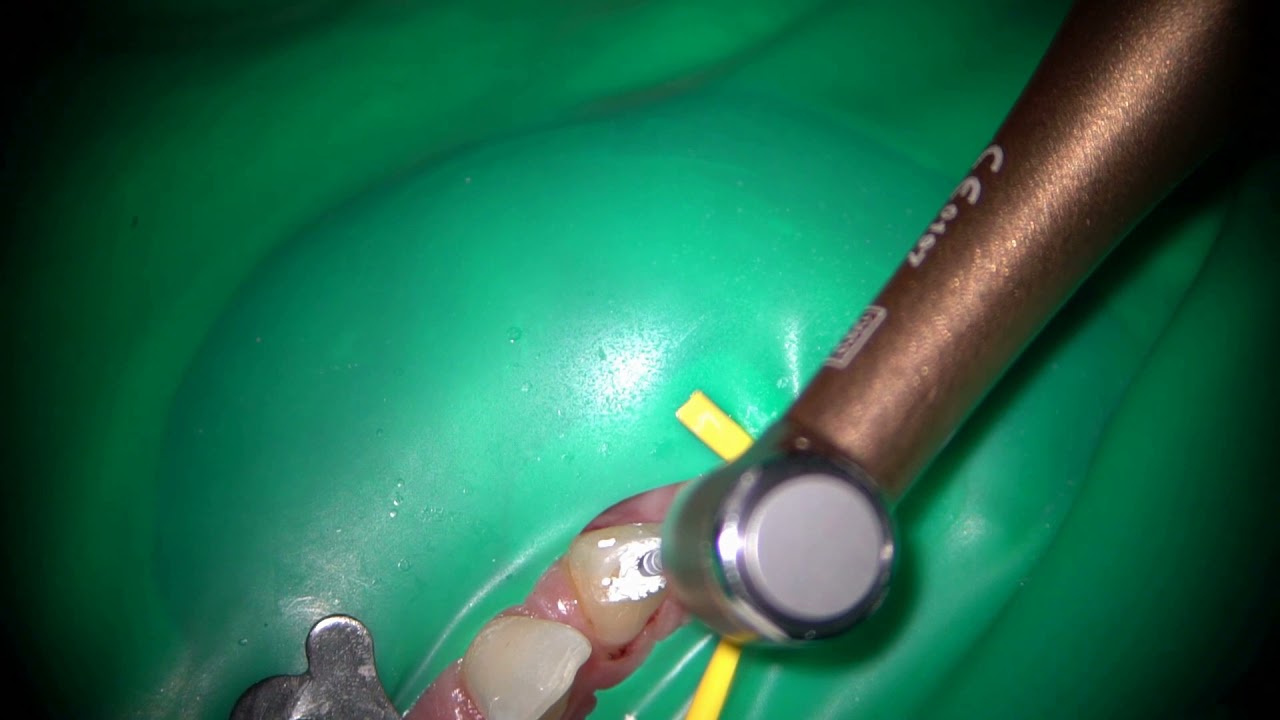 Root canal preparation to MTA obturation with an Ai motor Tmode YouTube