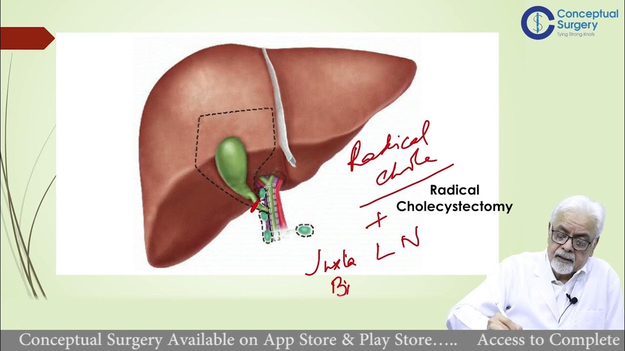 Principles of Surgical Obstruction Jaundice by Dr Vinod malik YouTube