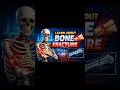 📚 Learn about bone fractures in an easy way! Understand how bones break,different types of fractures