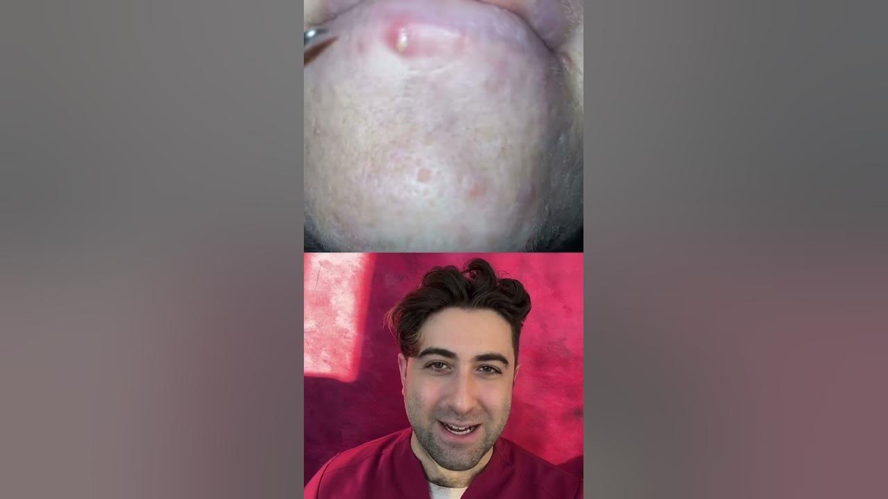 pimple-on-lower-lip-but-do-you-agree-with-the-technique-youtube