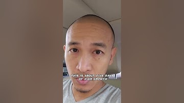 My Scalp Micropigmentation Healing Progress Day 5 #scalpmicropigmentation #scalptattoo