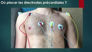 Réalisation d'un ECG et bon positionnement des électrodes_les chats noirs du 3SM