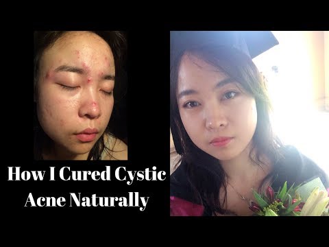 How I cured cystic acne naturally 👏罪魁祸首竟然是它？💁ud♀️ 我的抗痘经历，在吃异维A酸（accutane) 前的最后挣扎🙅ud♀️