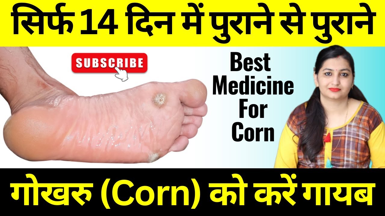 गोखरू को हमेशा के लिये ठीक कैसे करें Foot Corn Homeopathic Treatment