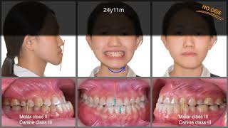 Nonsurgical treatment to correct Class III Malocclusion with Skeletal Asymmetry｜【Chris Chang Ortho】
