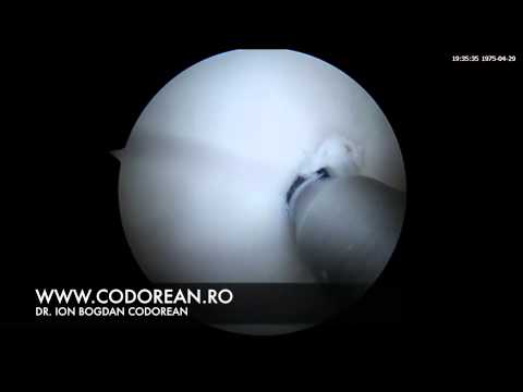 Video: Osteocondrita Disecantă (TOC) La Câini