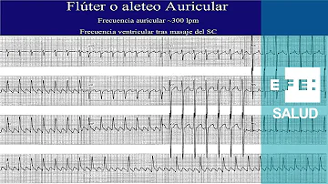 ¿Qué frecuencia cardiaca se considera fibrilación auricular?