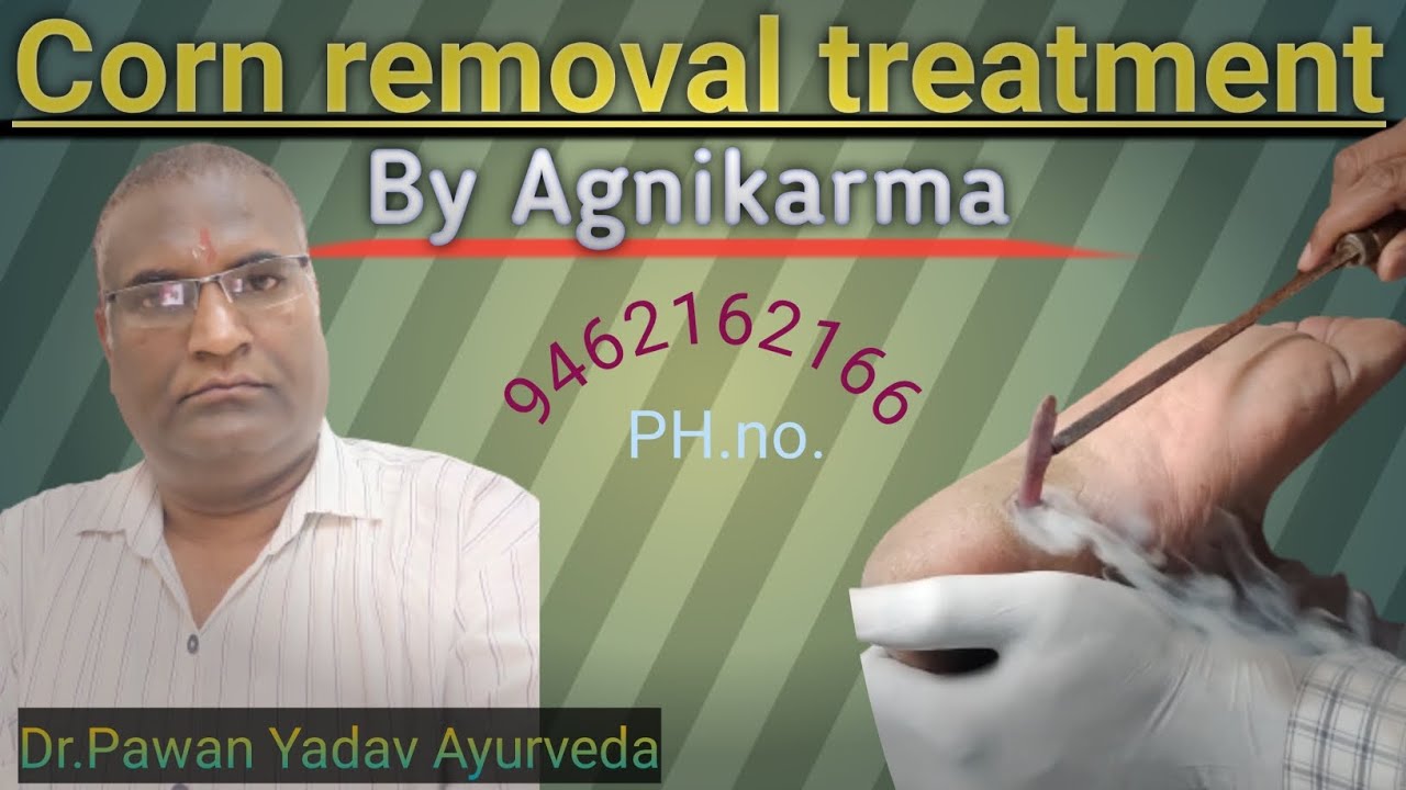 Deep Corn Extraction Deep corn removal treatment #ayurveda #doctors #agnikarma #trending ...