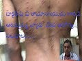 Homeopathy Treatment for Chickenpox -- Rajaram's Homeo hospital -- Dr.Rama Naidu - 7286880888