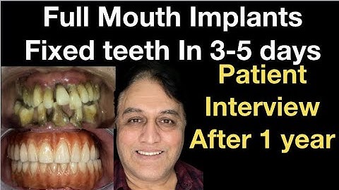 Full mouth extraction immediate dentures near me