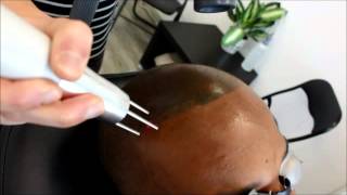 Slechte gezette MHP verwijderen  Beauty Care Nederland