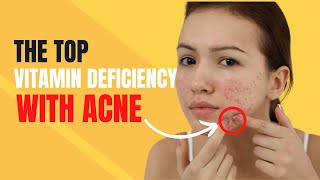The Top Vitamin Deficiency with Acne in 2023