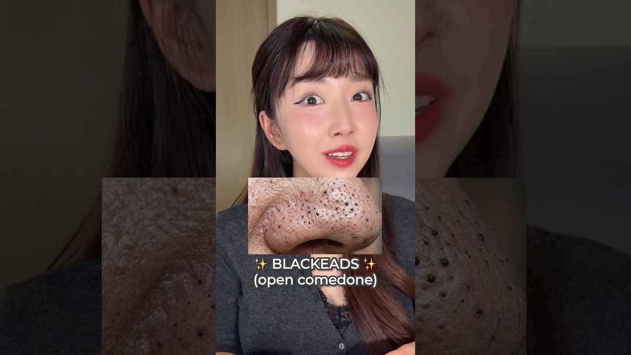 INI ALASAN KENAPA KALIAN KOMEDOAN TERUS !