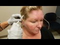 Botox for Migraines at Mercy