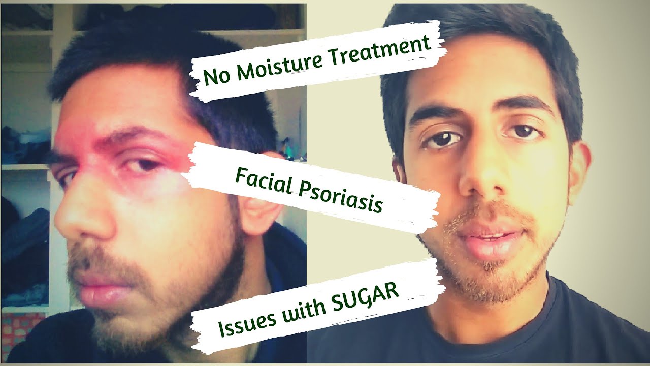 no moisture treatment eczema