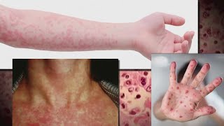 Ohio Department of Health investigating potential measles outbreak