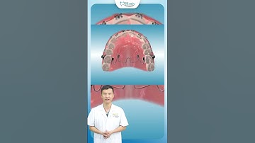 Khí Cụ Xoay Răng | Nha Khoa Minh Châu