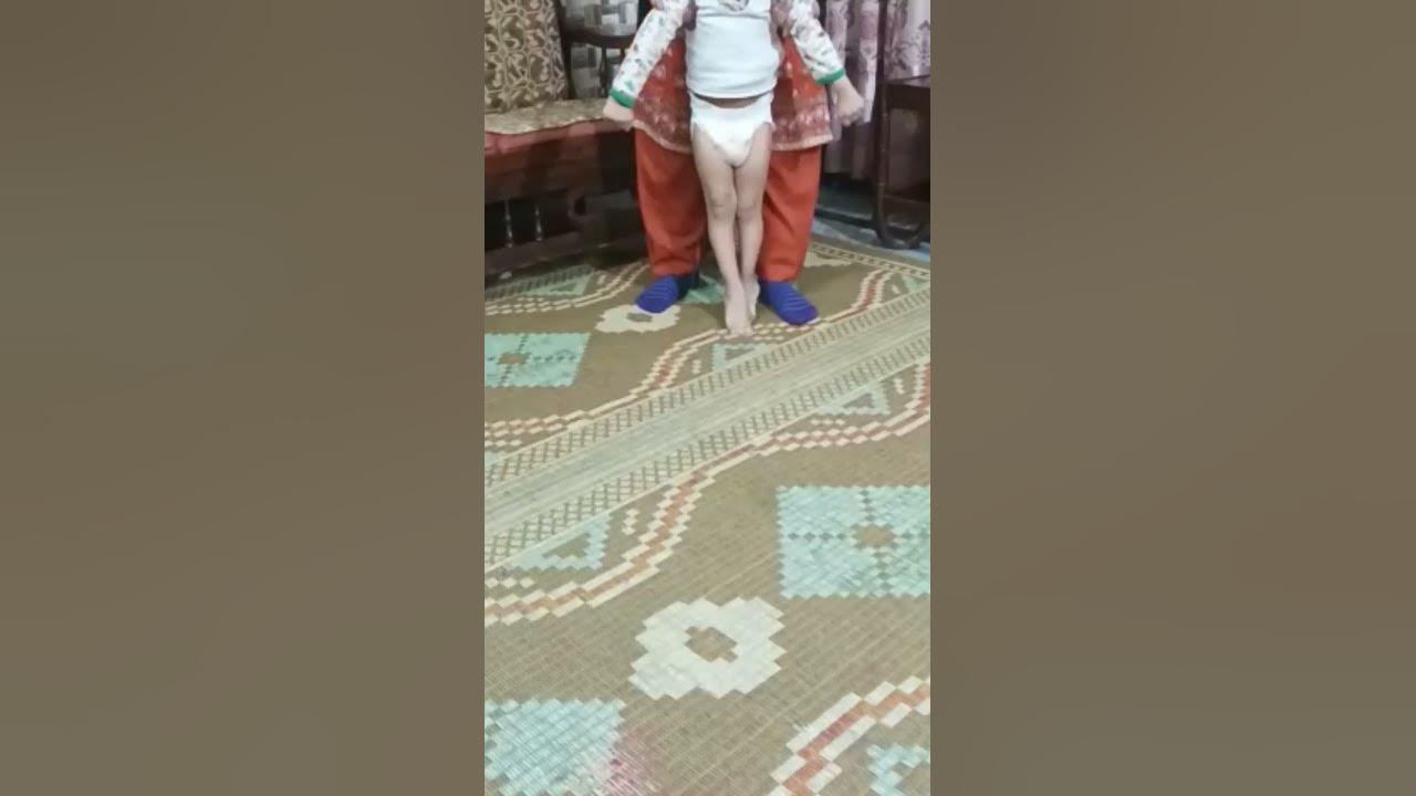 Scissor Gait in cerebral palsy compared with normal mother's gait