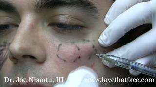 Cheek Filler Injection Made Easy