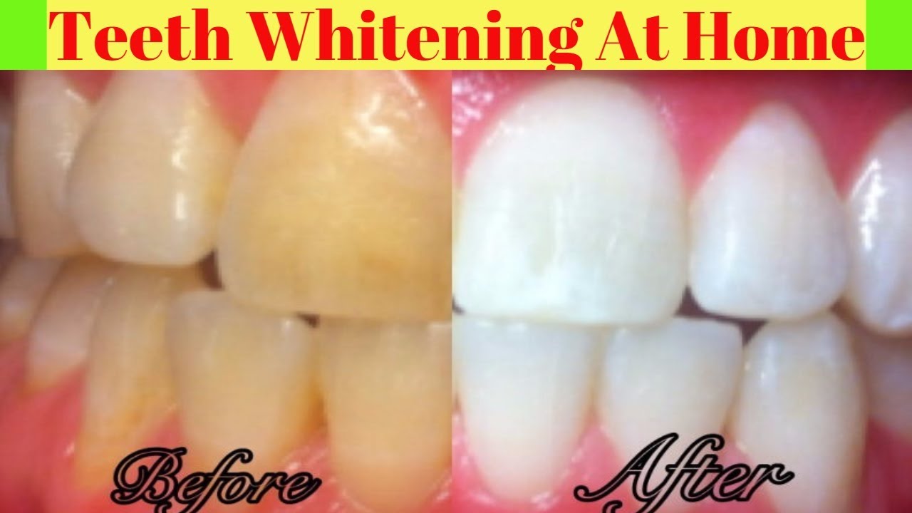 How To Whiten Yellow Teeth From Smoking