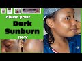 Whitening Facial Creams to clear Sunburn fast| face cream reviews for uneven skin &hyperpigmentation