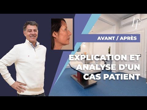 Cas Patient : Rajeunissement global avec fils tenseurs permanents